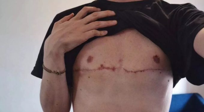 Las personas transexuales también deben estar atentas a los signos del cáncer de mama