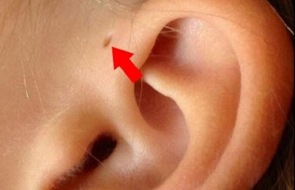 ¿Por qué algunas personas tienen un pequeño agujero en la oreja?