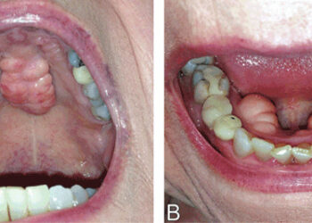 Torus mandibular: el crecimiento de hueso que podría deformar tu boca por bruxismo