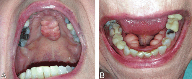 Torus mandibular: el crecimiento de hueso que podría deformar tu boca por bruxismo