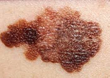 Avance de la inmunoterapia contra el melanoma