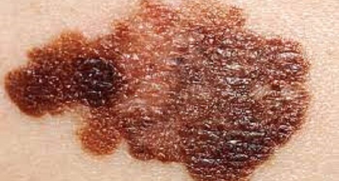 Avance de la inmunoterapia contra el melanoma