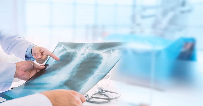 YES1, la proteína que podría combatir el cáncer de pulmón