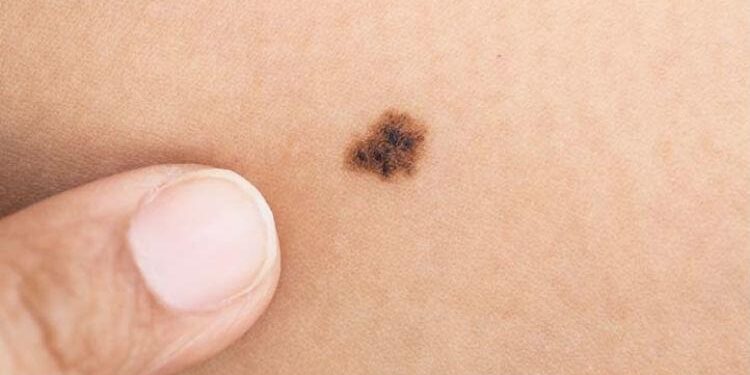 La 29va Campaña Nacional del Prevención del Cáncer de piel de la Sociedad Argentina de Dermatología