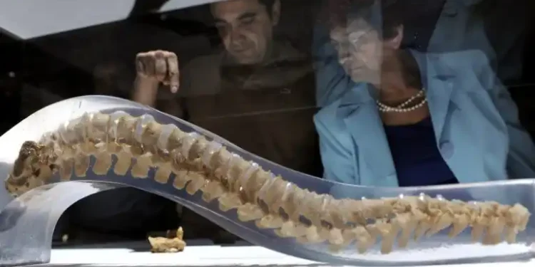 Fractura de vértebras por osteoporosis: Mujer, 76 años y no siempre tratada