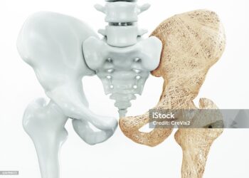 La osteoporosïs podría frenarse, según un estudio de la Universidad de Cantabria (UC)