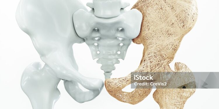 La osteoporosïs podría frenarse, según un estudio de la Universidad de Cantabria (UC)