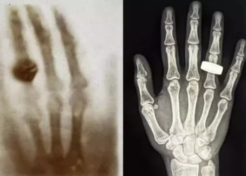 Una mano con un anillo, la primera radiografía en el espacio