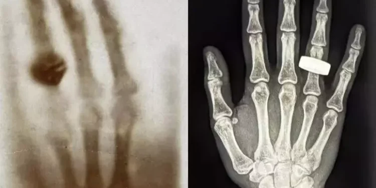 Una mano con un anillo, la primera radiografía en el espacio