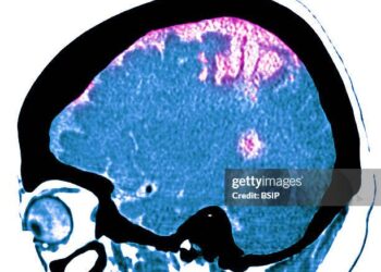 Síntomas de un ataque o derrame cerebral