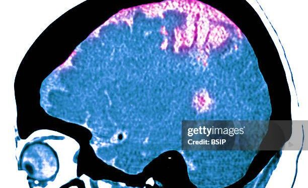 Síntomas de un ataque o derrame cerebral