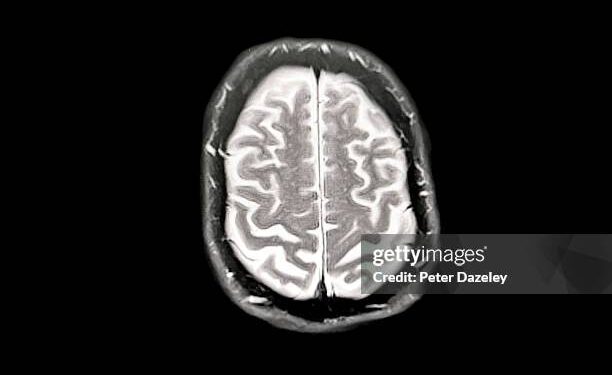 Descubren una proteína que rejuvenece el cerebro y podría revertir el Alzheimer