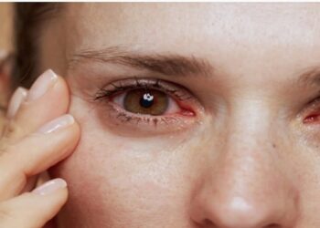 El Síndrome de Sjögren es un trastorno crónico del sistema inmunitario