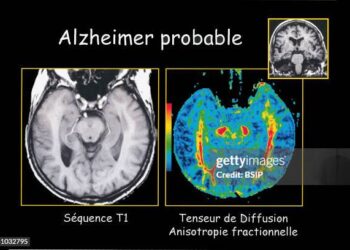 Dos medicamentos aprobados por la FDA logran revertir el Alzheimer en estudio preclínicos