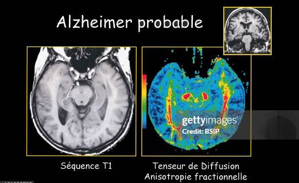 Dos medicamentos aprobados por la FDA logran revertir el Alzheimer en estudio preclínicos