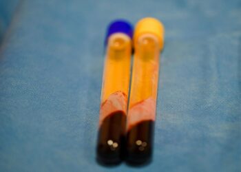 Las personas con este tipo de sangre tienen mayor riesgo de sufrir un derrame cerebral