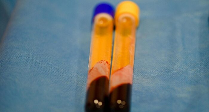 Las personas con este tipo de sangre tienen mayor riesgo de sufrir un derrame cerebral
