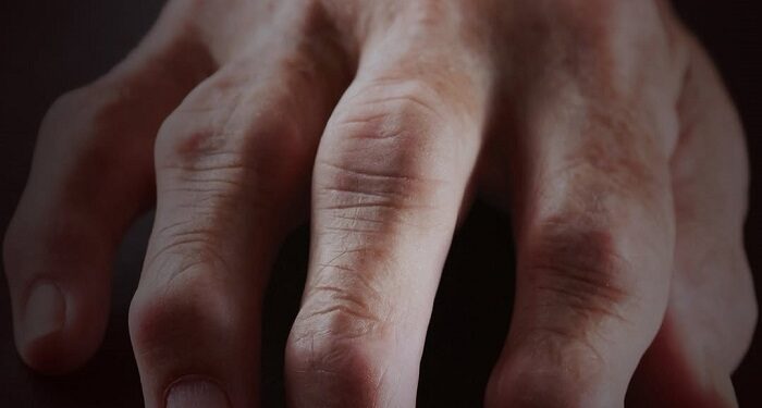 Revelan síntomas de artritis reumatoidea antes de que aparezca la enfermedad