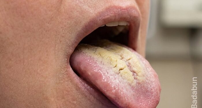 Además de los dientes, la lengua también debe lavarse todos los días