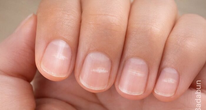 ¿Qué significan las manchas blancas en las uñas?