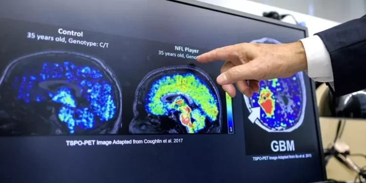 Hábitos saludables, la mejor herramienta contra el Alzheimer