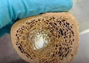 Un medicamento para la tiroides podría estar debilitando los huesos en adultos mayores
