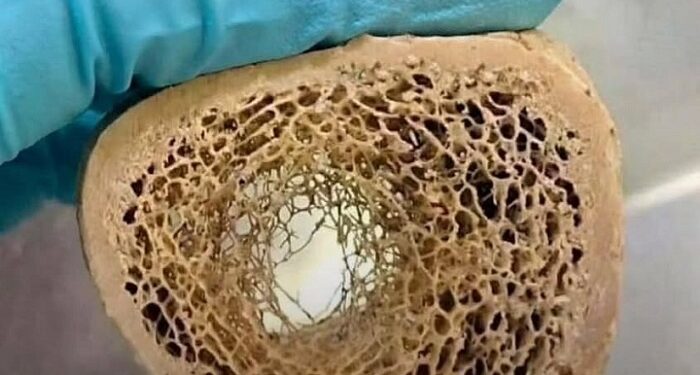 Un medicamento para la tiroides podría estar debilitando los huesos en adultos mayores